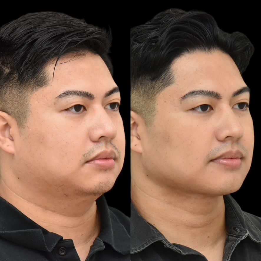 Chin Liposuction Before & After