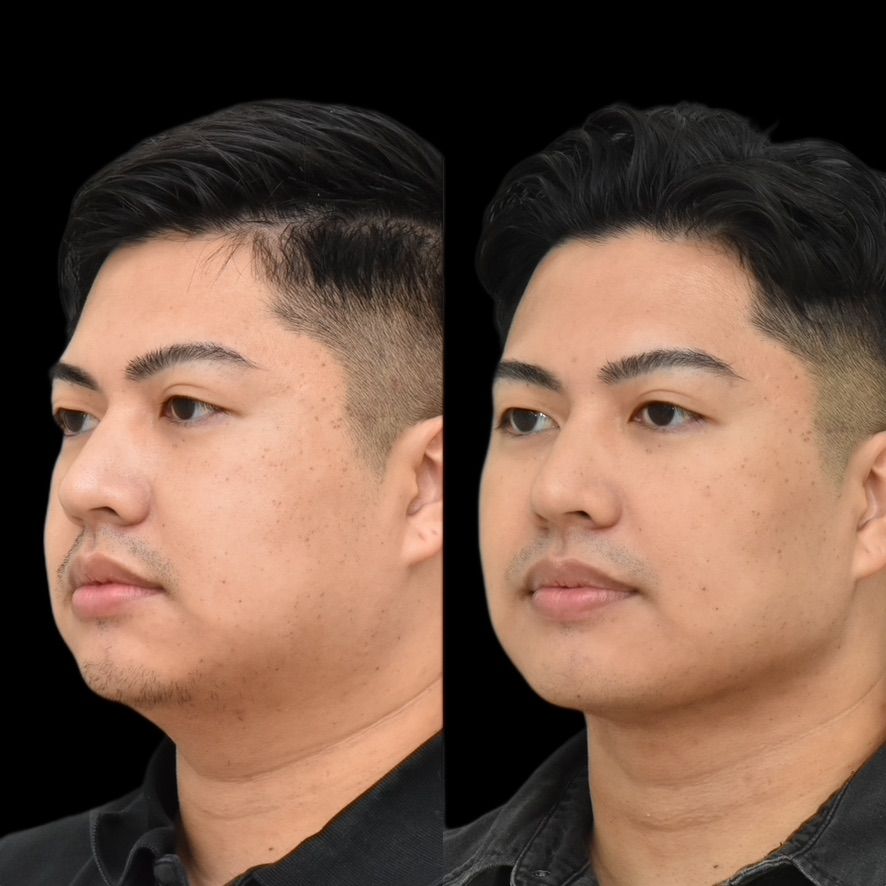 Chin Liposuction Before & After
