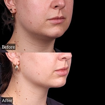 Chin Liposuction Before & After