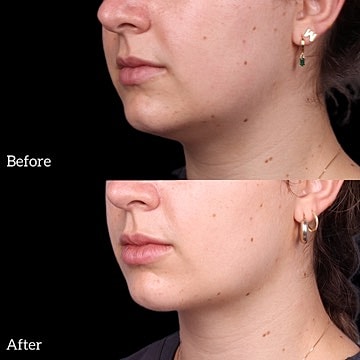 Chin Liposuction Before & After