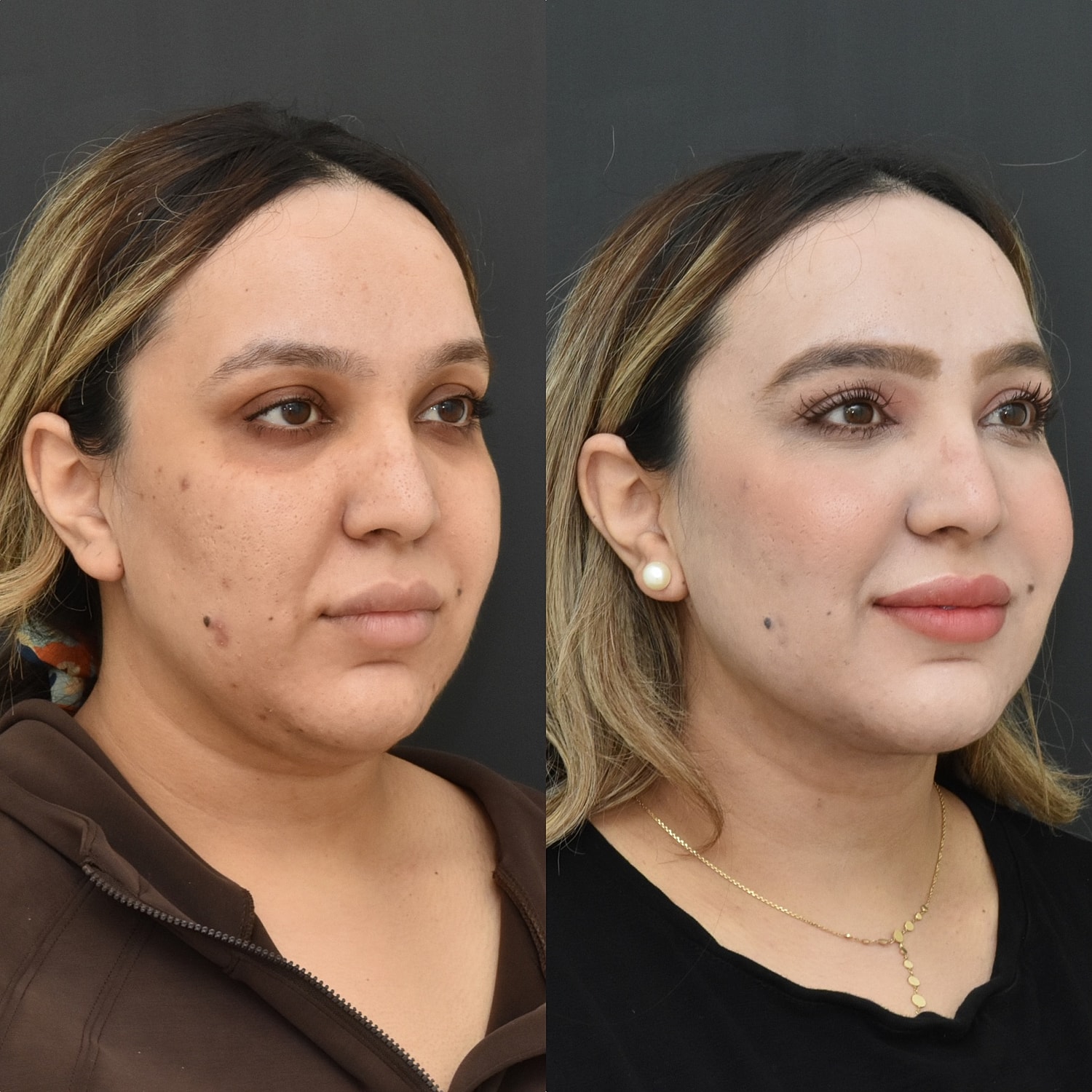 Chin Liposuction Before & After