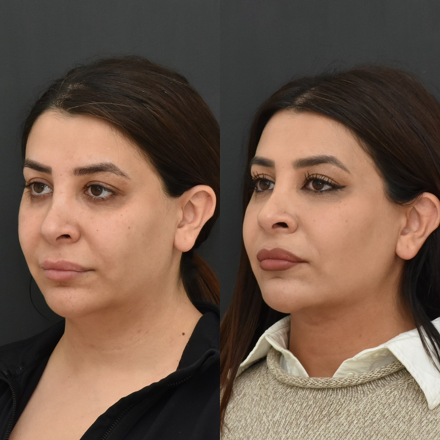 Chin Liposuction Before & After