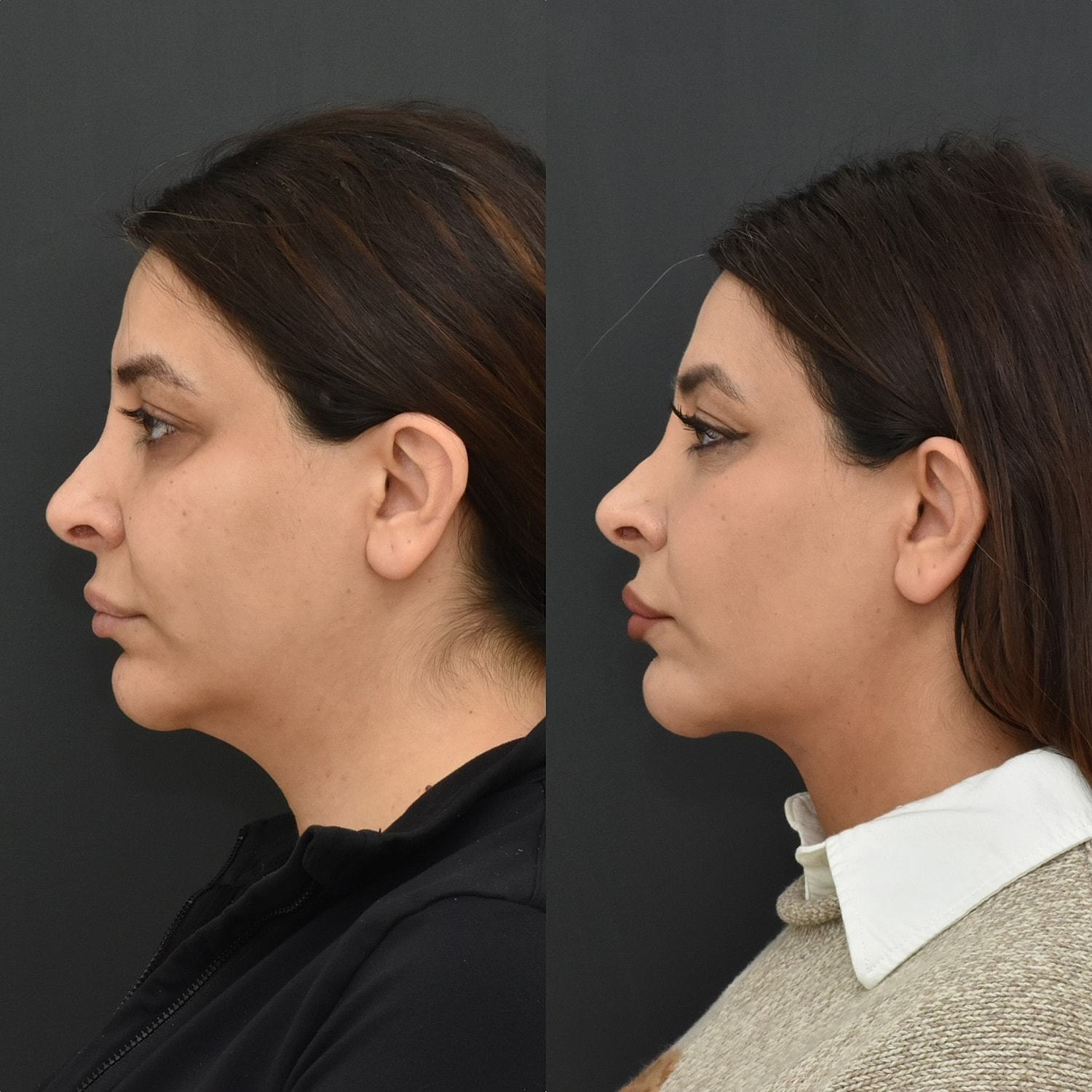 Chin Liposuction Before & After