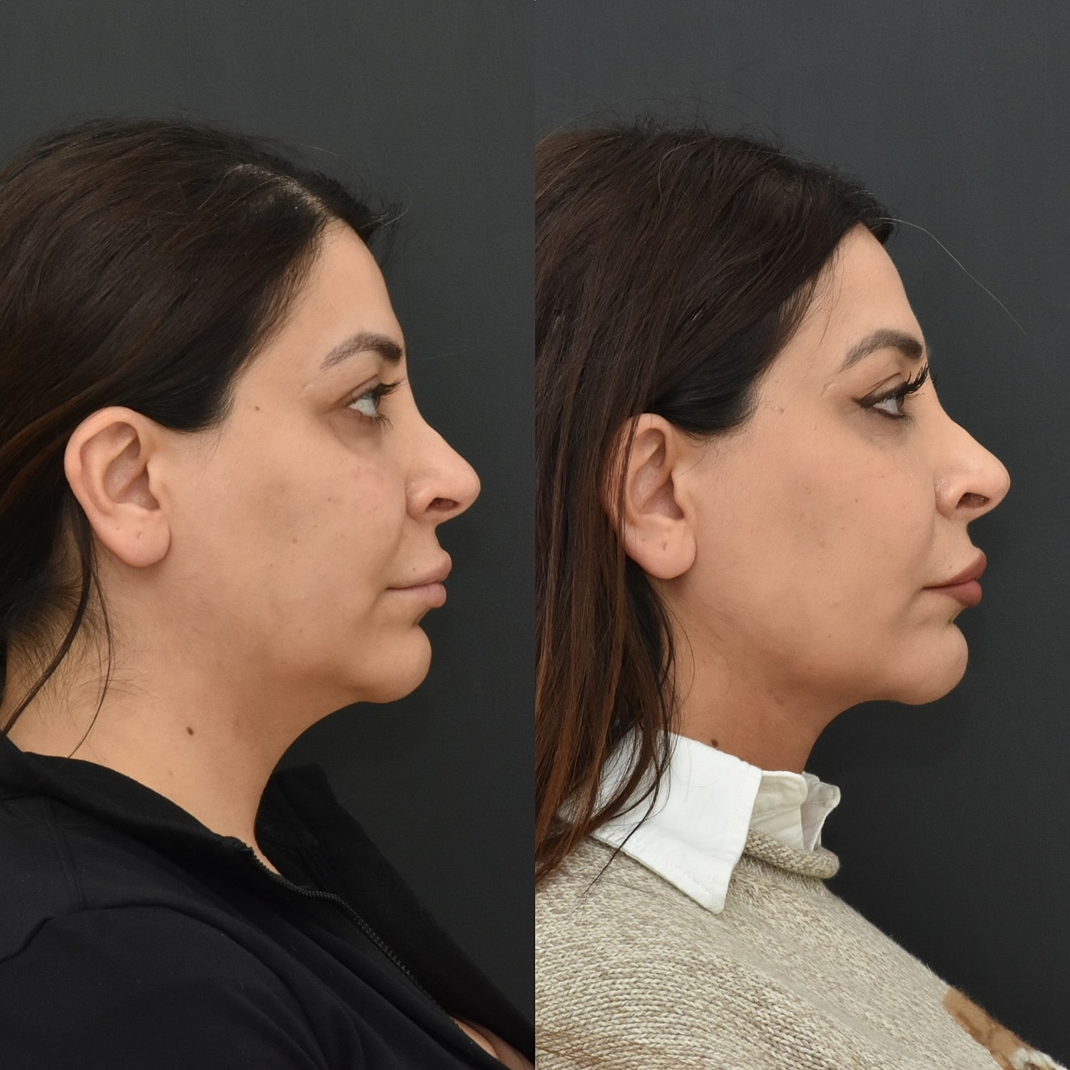 Chin Liposuction Before & After