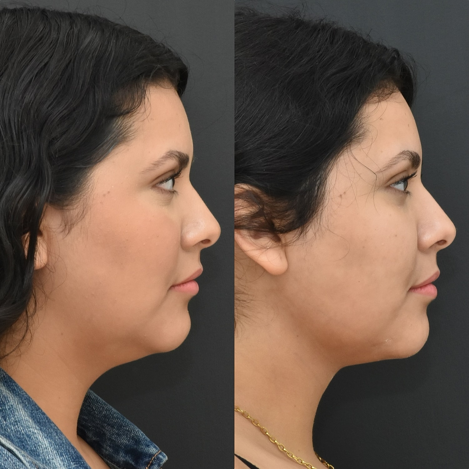 Chin Liposuction Before & After