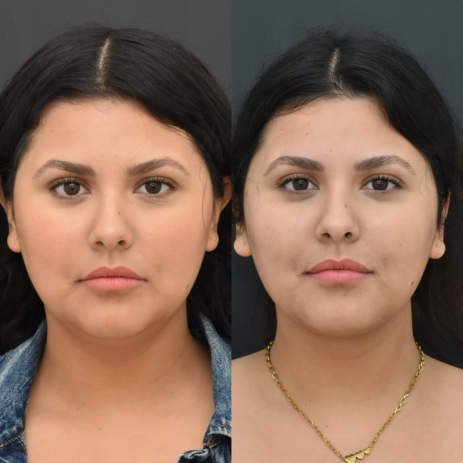 Chin Liposuction Before & After