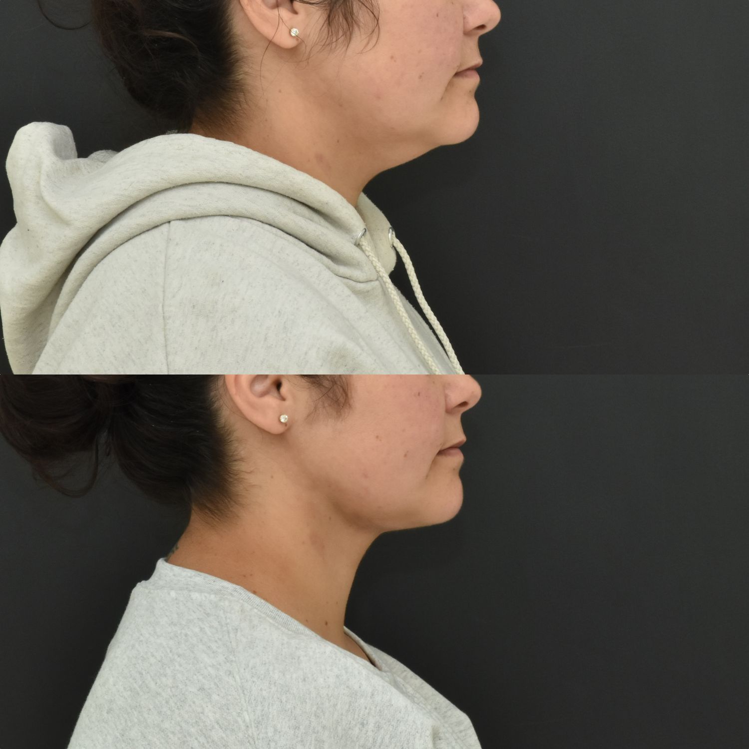 Chin Liposuction Before & After