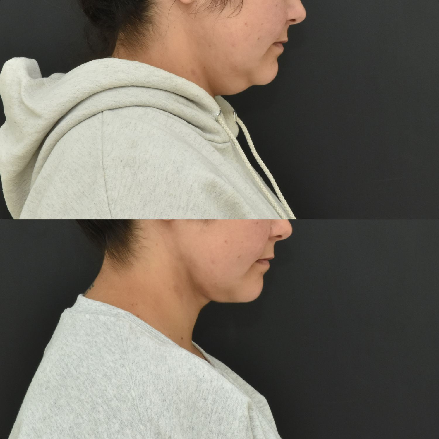 Chin Liposuction Before & After