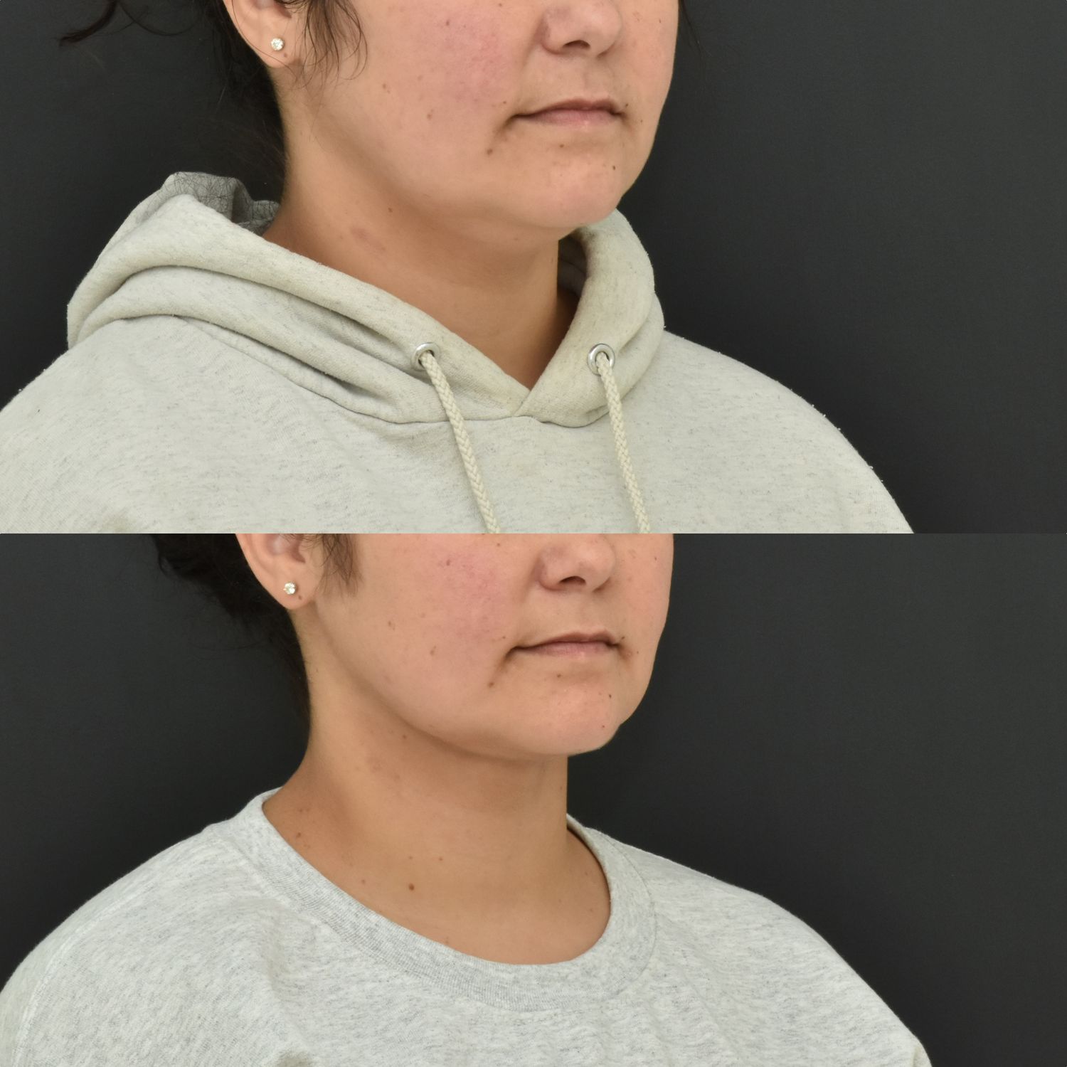 Chin Liposuction Before & After