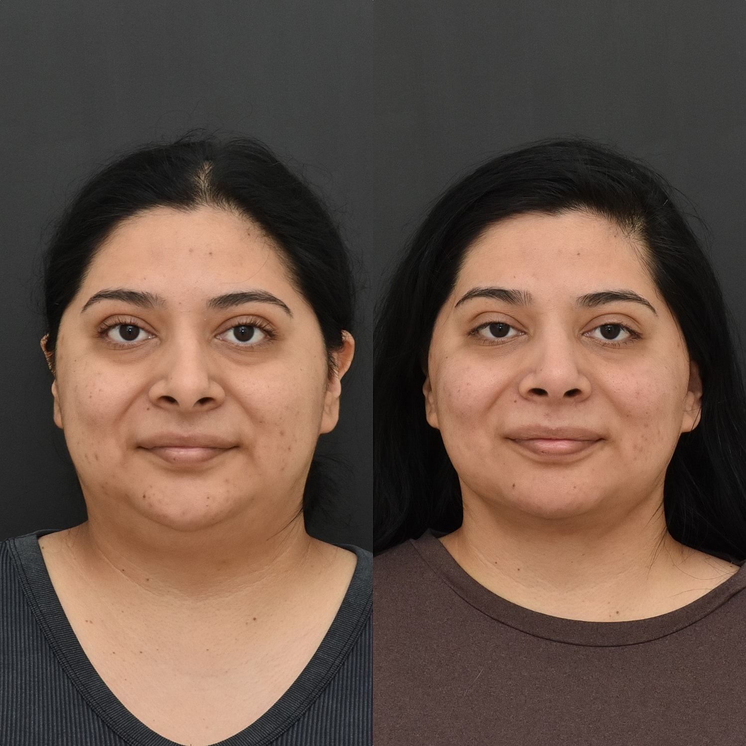 Chin Liposuction Before & After