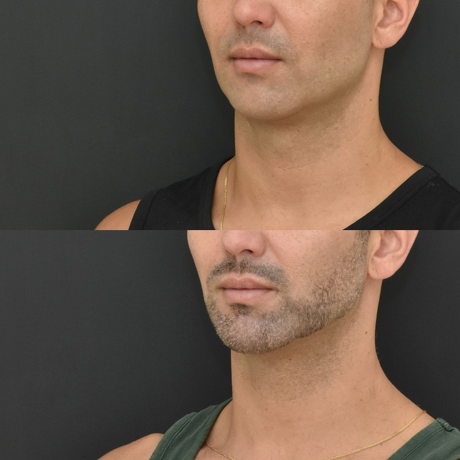 Male Neck Lift  Before & After