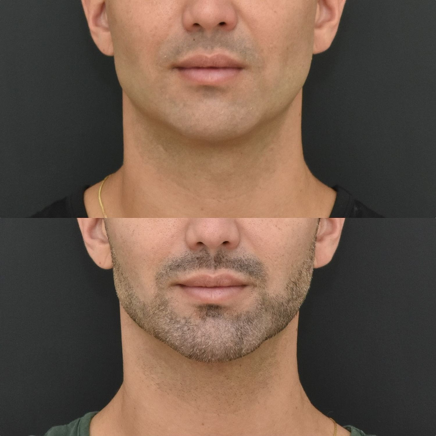 Male Neck Lift  Before & After