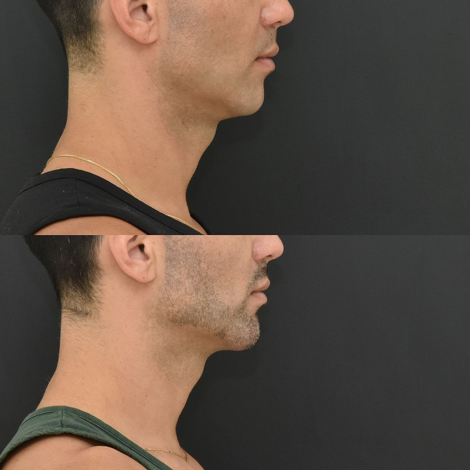 Male Neck Lift  Before & After