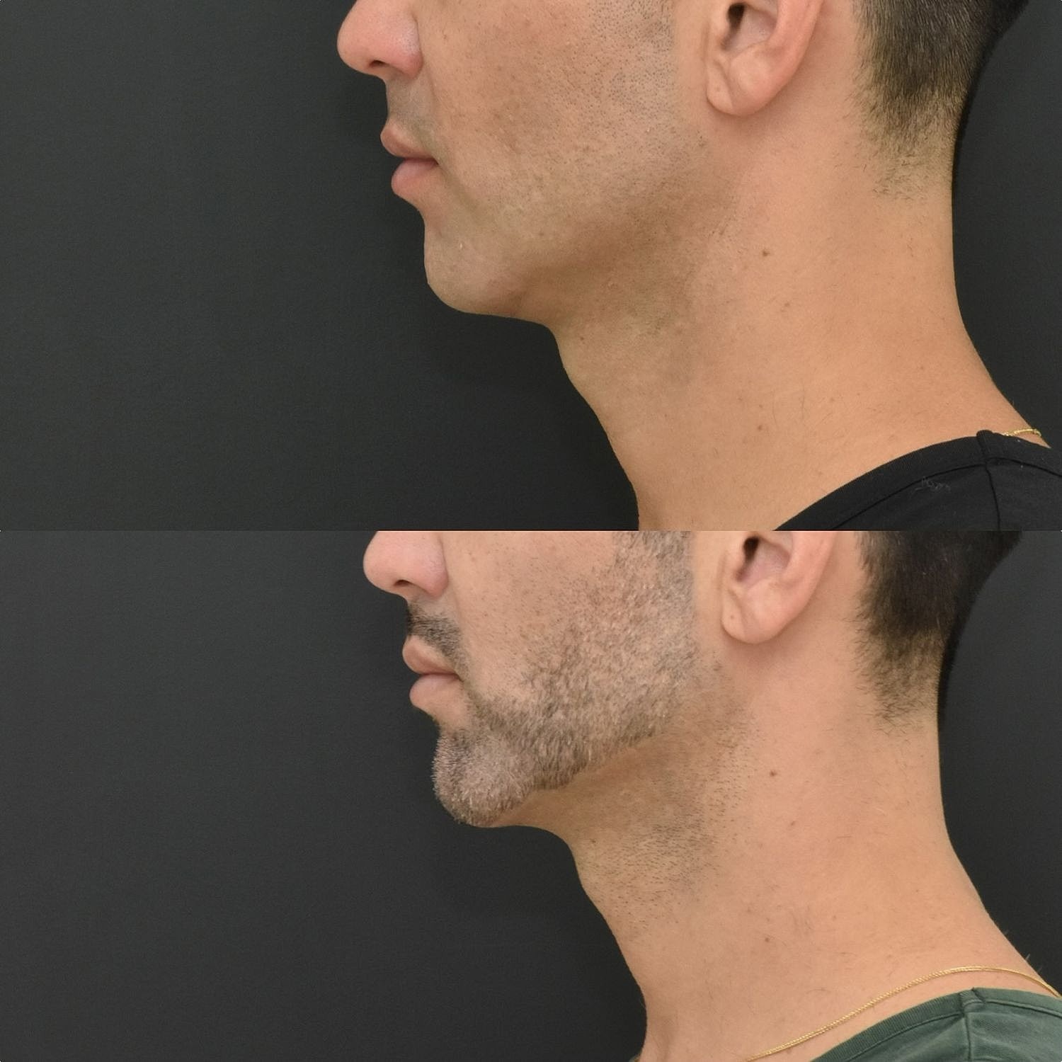 Male Neck Lift  Before & After