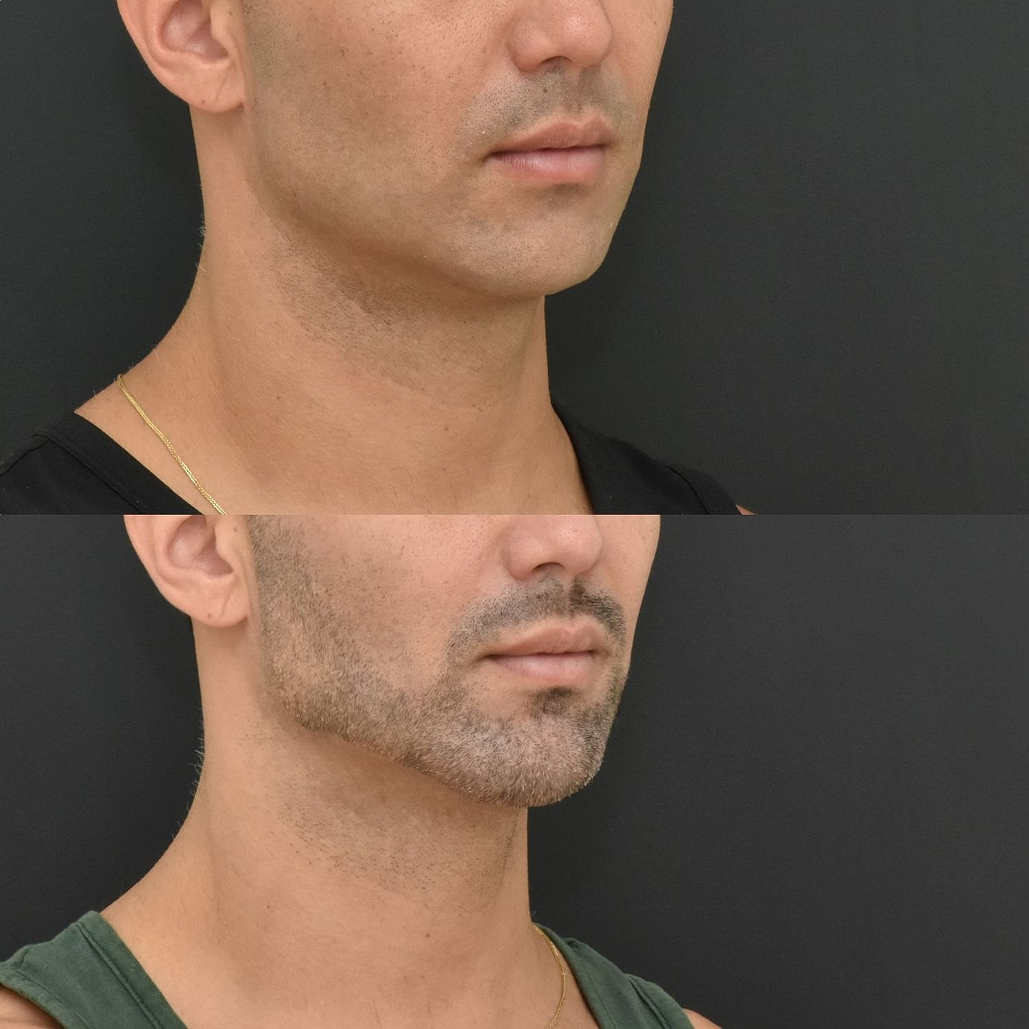 Male Neck Lift  Before & After