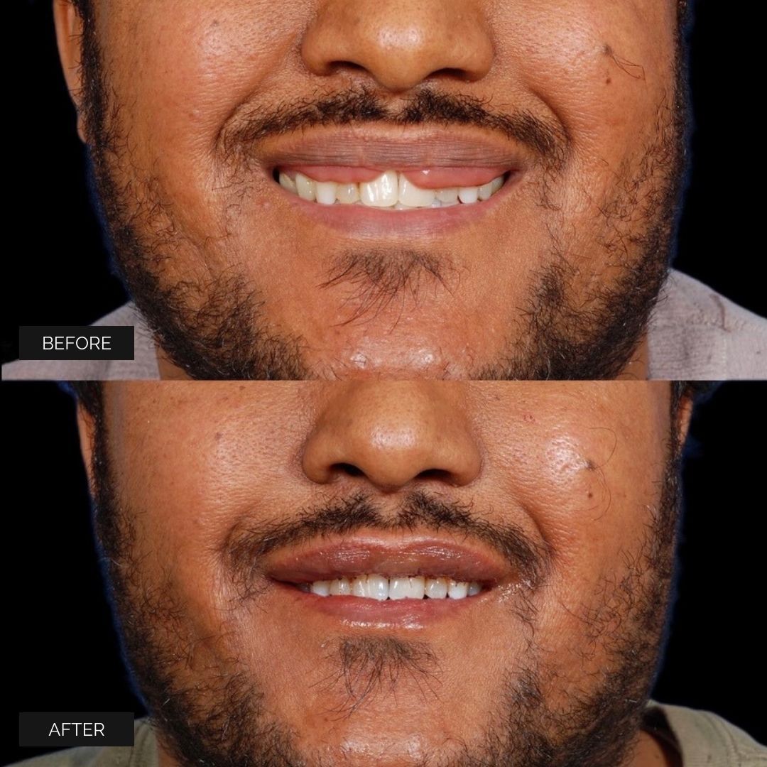 Reconstruction Before & After