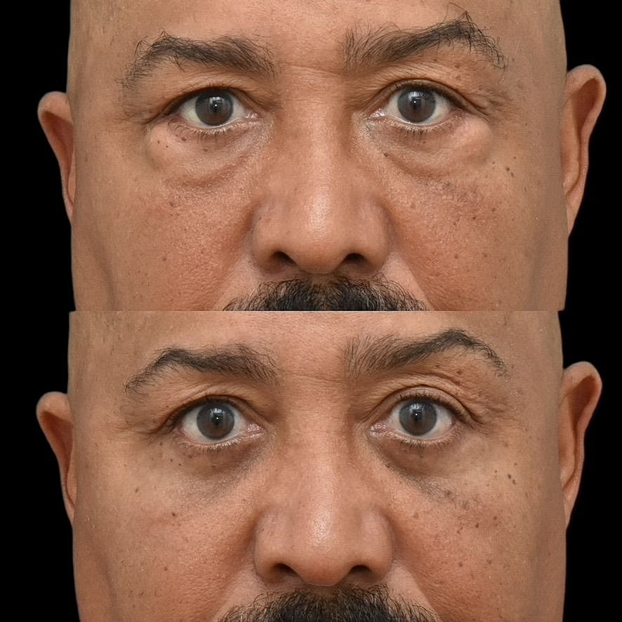 Male Blepharoplasty Before & After