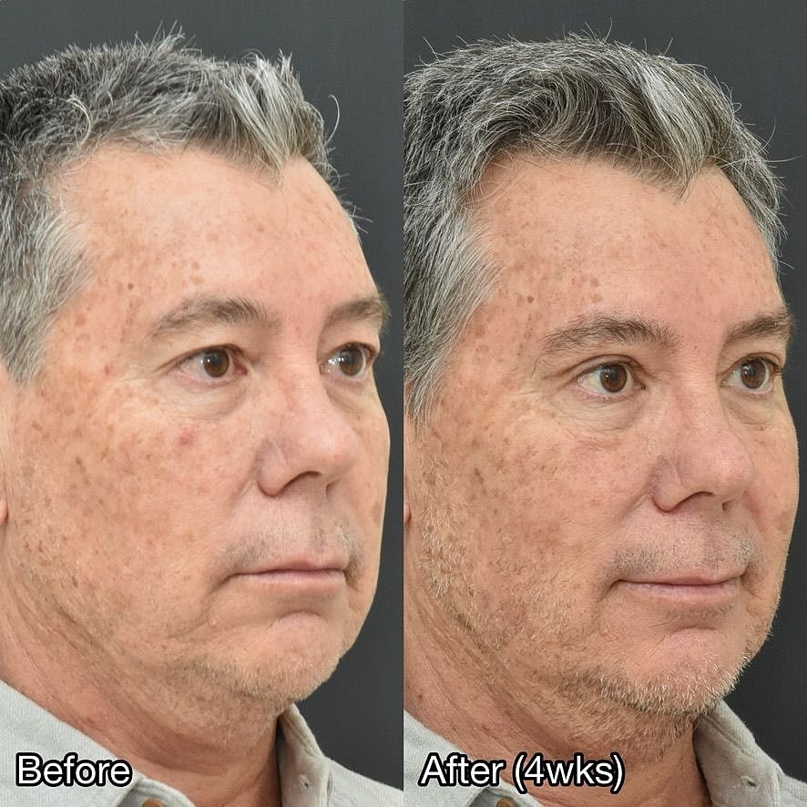 Male Blepharoplasty Before & After