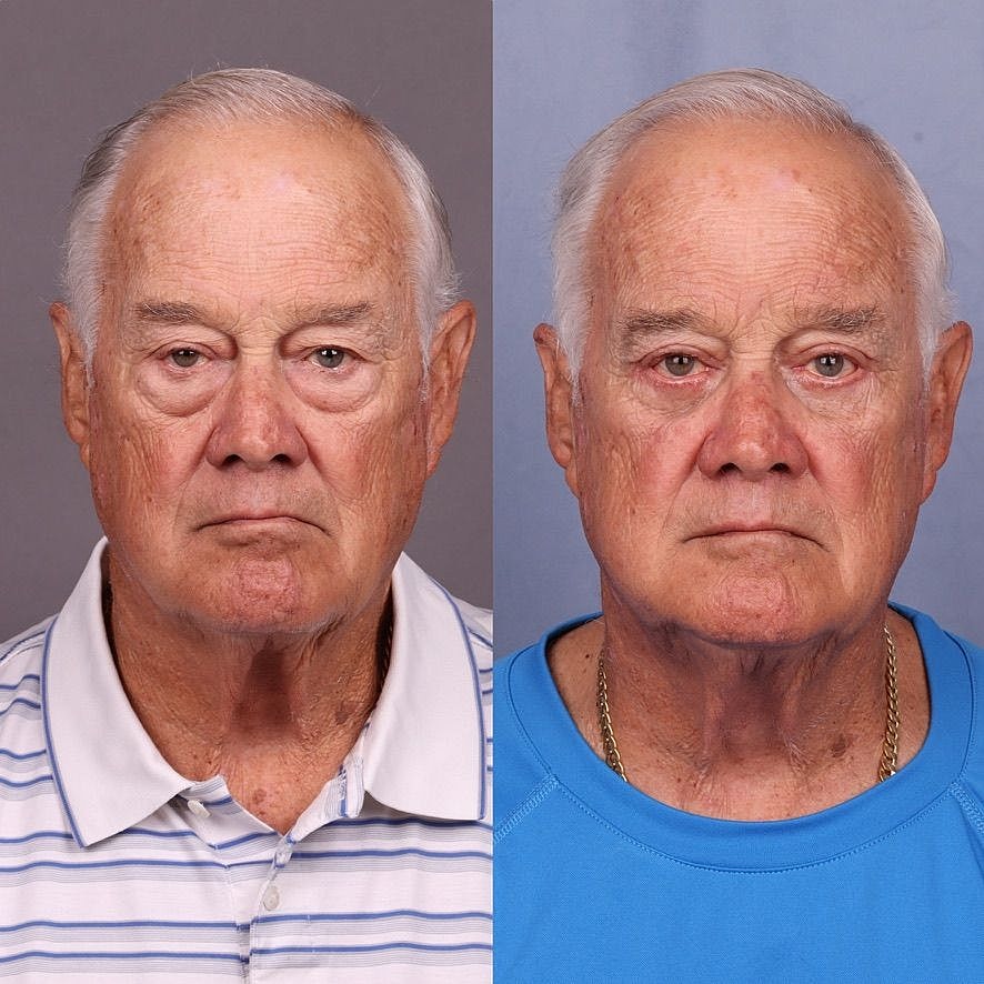 Male Blepharoplasty Before & After