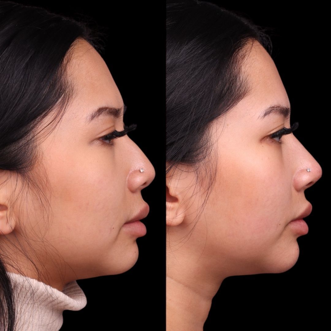 Liquid Rhinoplasty Before & After