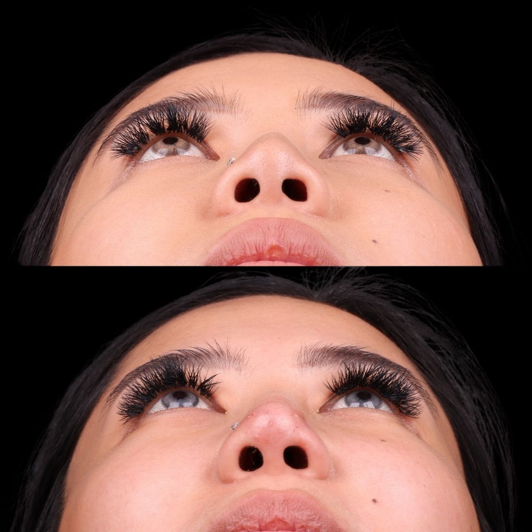 Liquid Rhinoplasty Before & After
