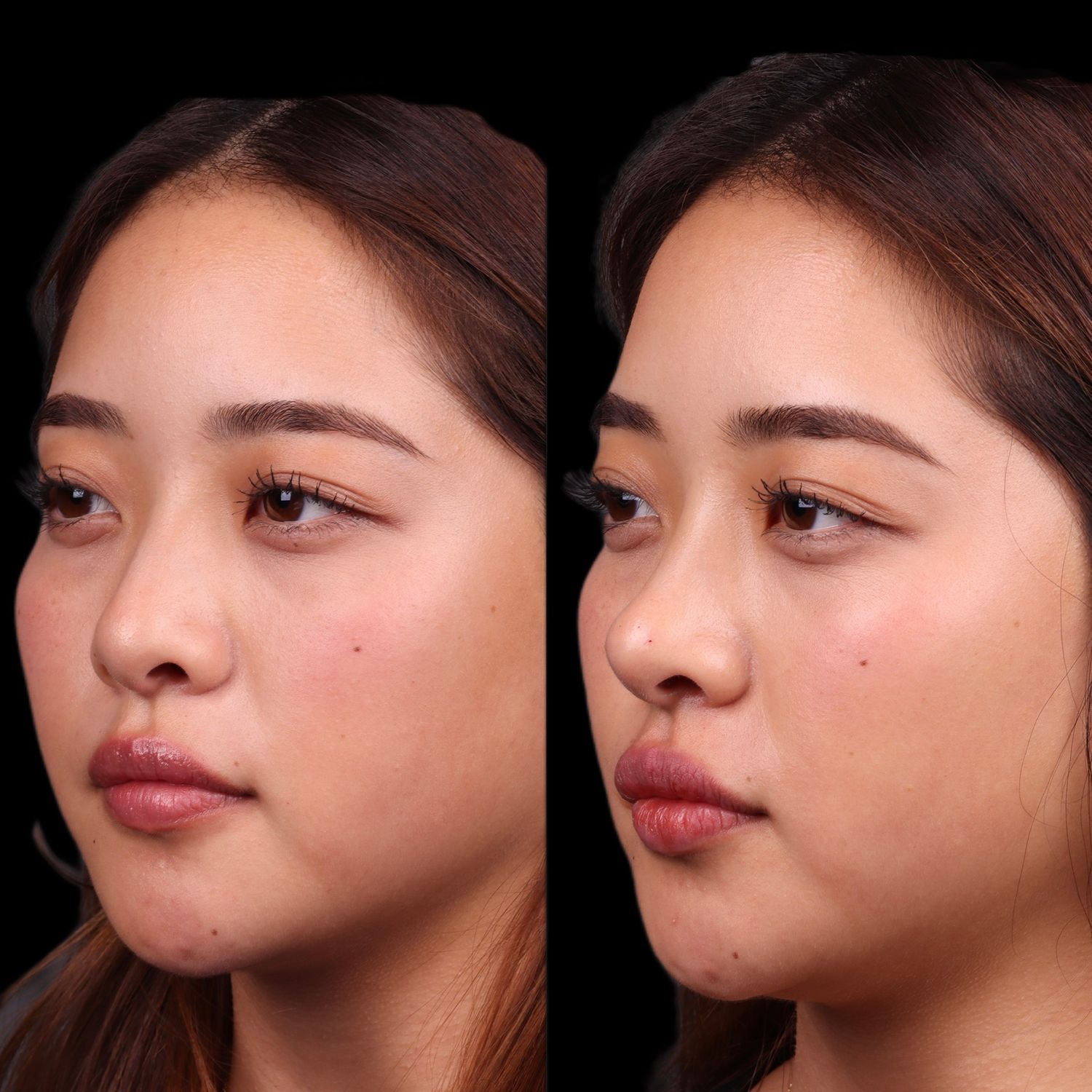 Liquid Rhinoplasty Before & After