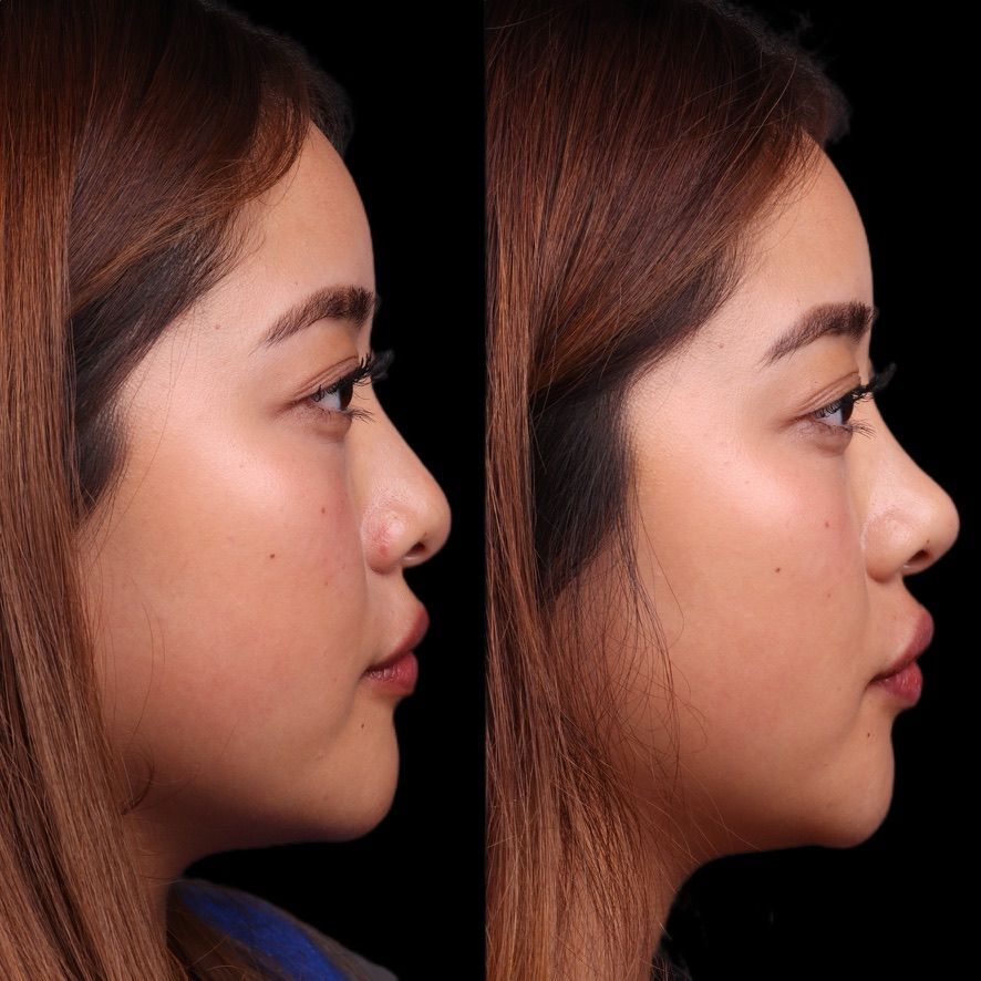 Liquid Rhinoplasty Before & After