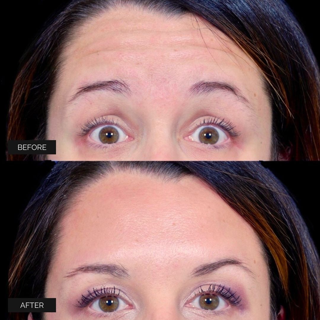 Facial Injectables & Fillers  Before & After