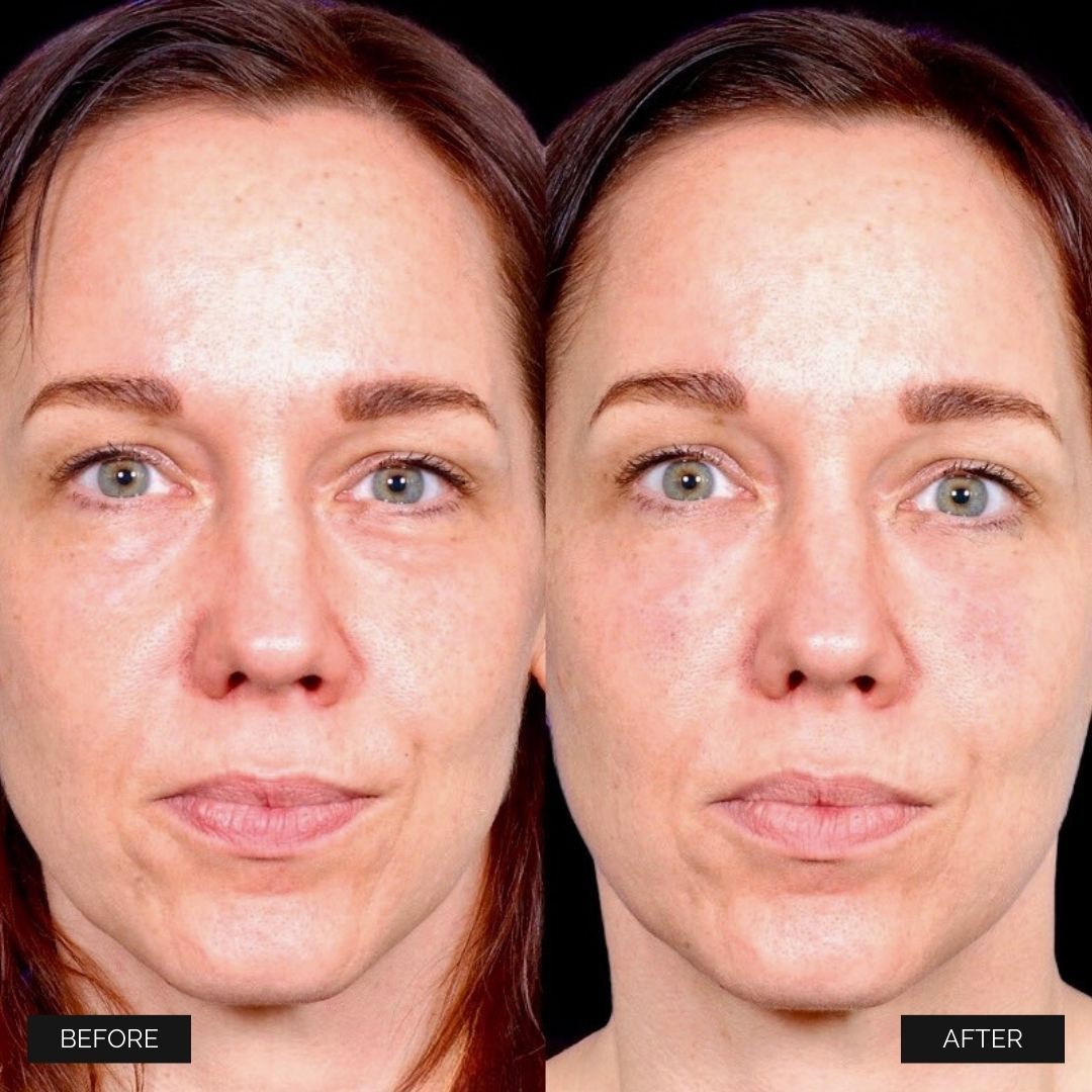 Facial Injectables & Fillers  Before & After