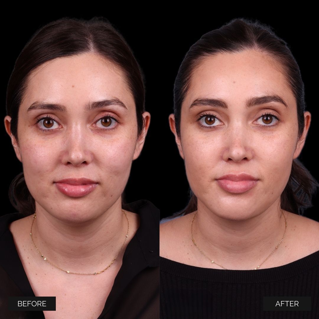 Facial Injectables & Fillers  Before & After