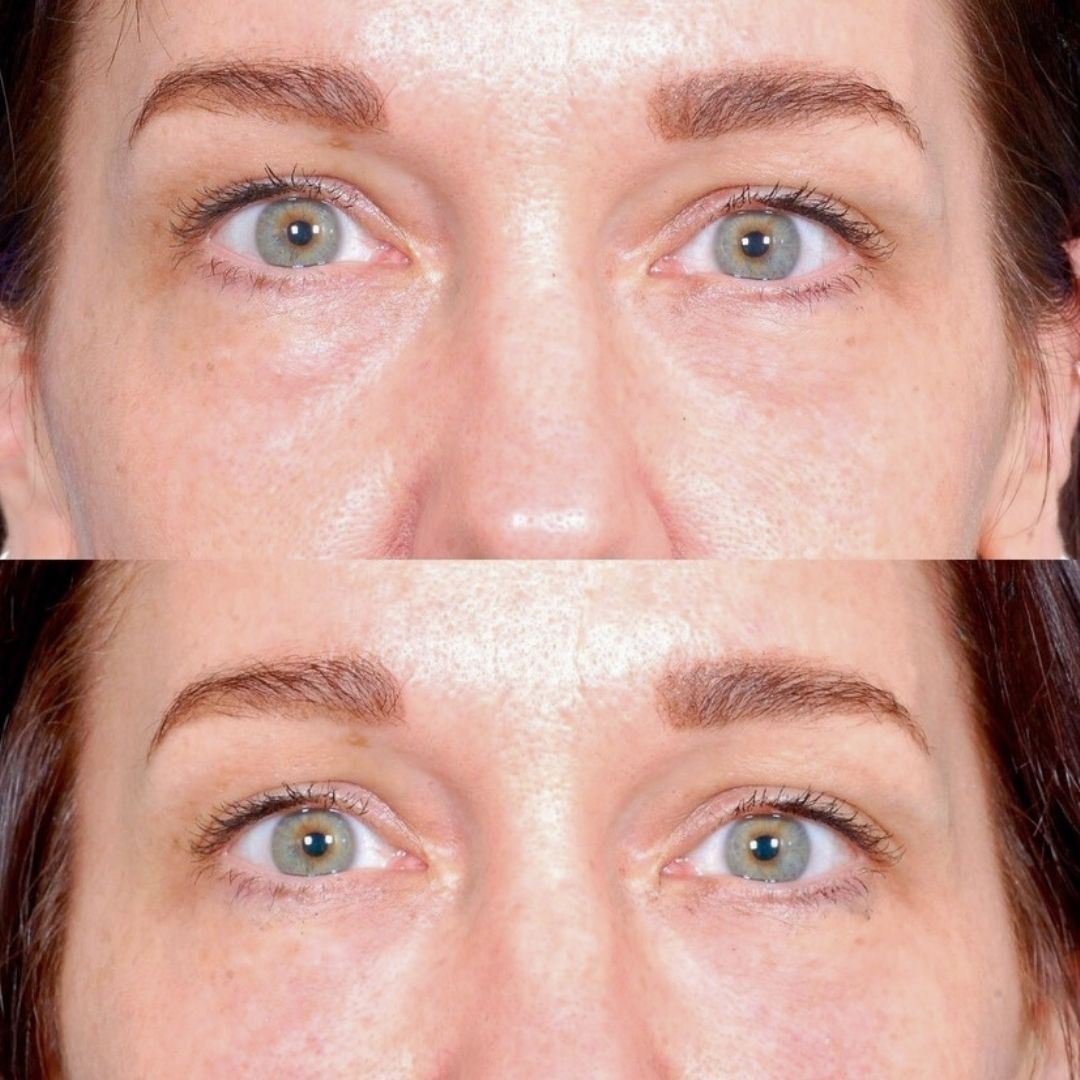 Facial Injectables & Fillers  Before & After