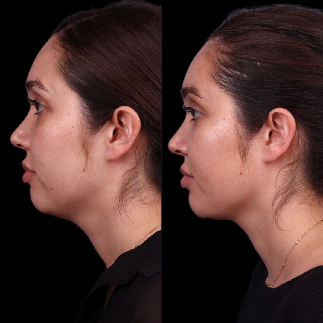 Facial Injectables & Fillers  Before & After