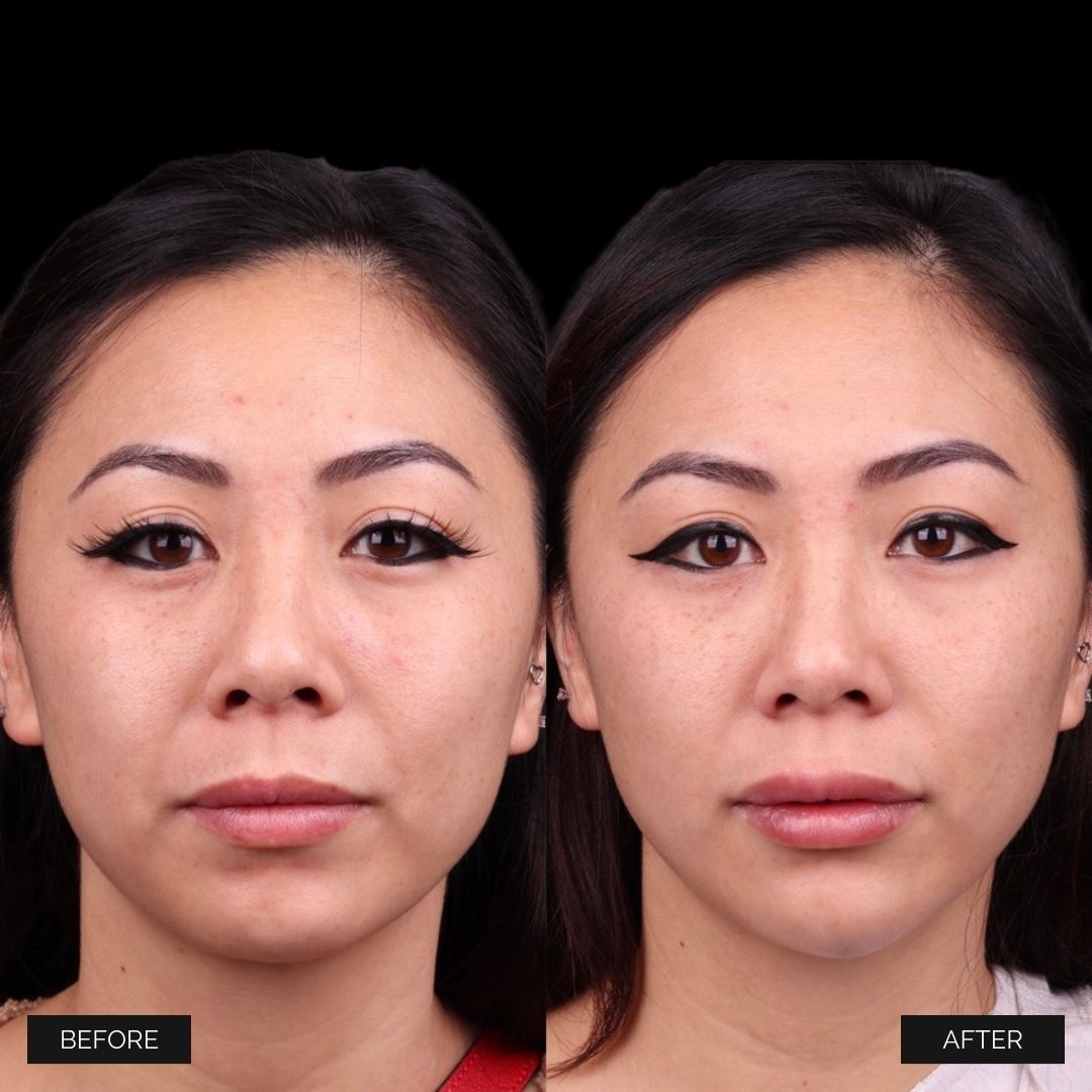 Facial Injectables & Fillers  Before & After