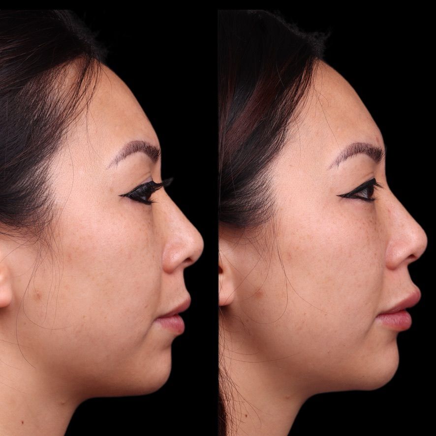 Facial Injectables & Fillers  Before & After
