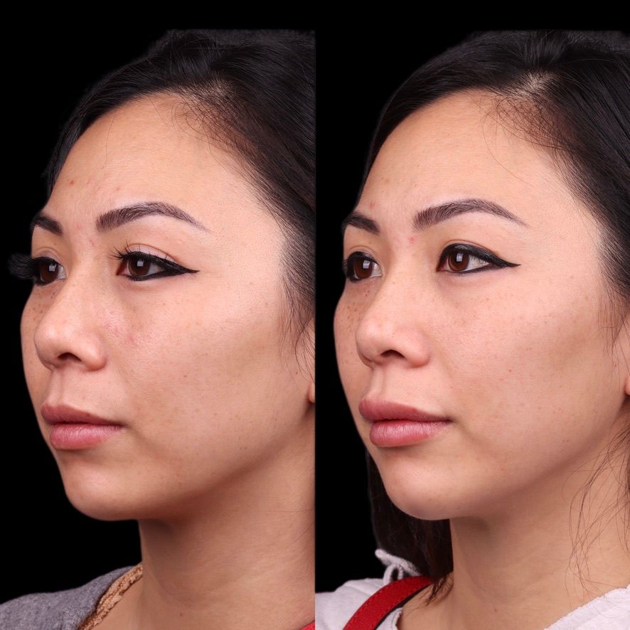 Facial Injectables & Fillers  Before & After