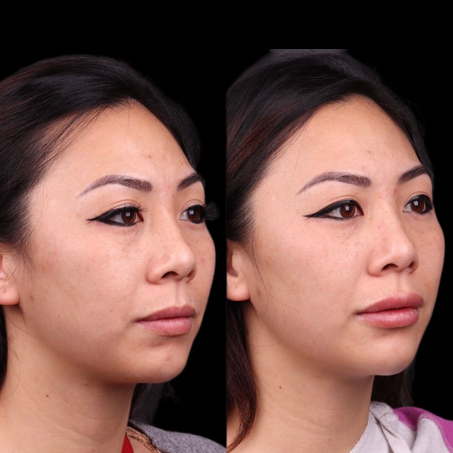 Facial Injectables & Fillers  Before & After