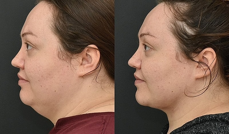 Before and after profile comparison of a woman.